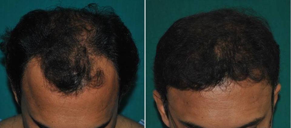 Hair implant photo, Kerala, India